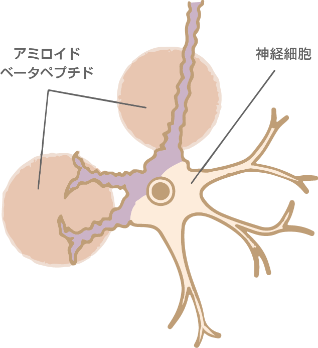 Apoe遺伝子検査 認知症のリスクを知って予防しましょう 健康診断 人間ドック さくら病院